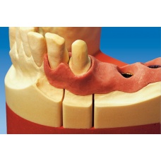 DaVinci's Majesthetik® - Gingiimplant  dantenų imitacija specialiai implantavimo technikai